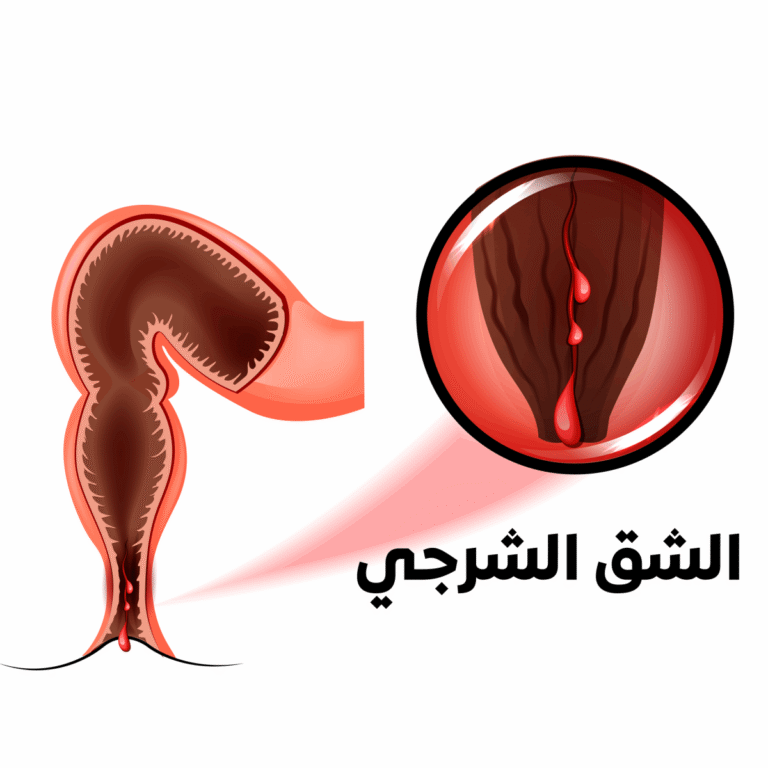 علاج الشرخ الشرجي بالليزر في الأردن