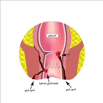 أسباب الناسور وأعراضه
