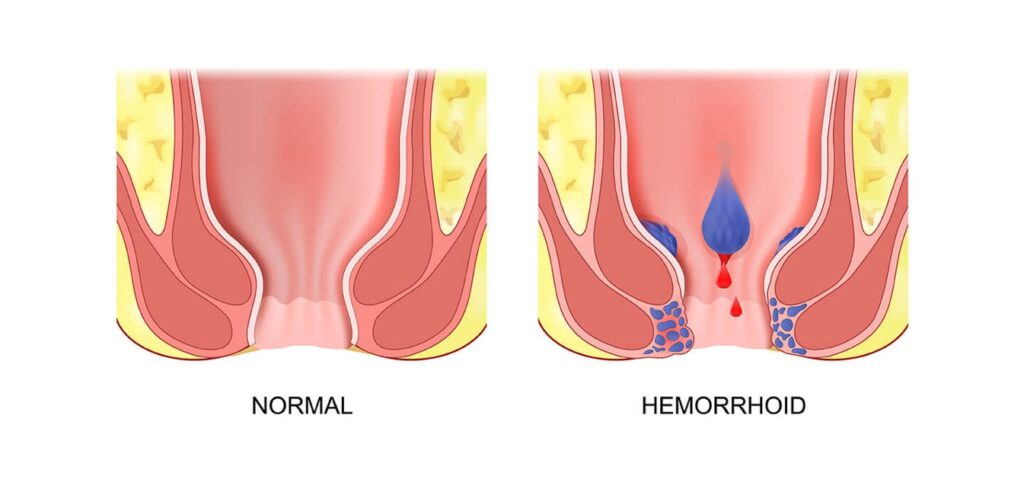 علاج البواسير عند البالغين