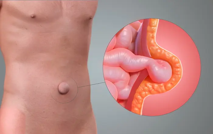 أعراض الفتق السري عند الكبار