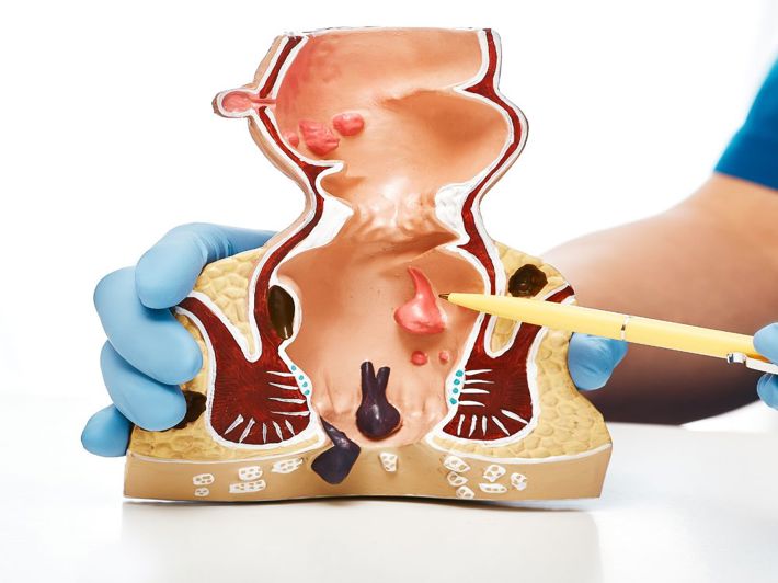 أعراض البواسير الداخلية والخارجية