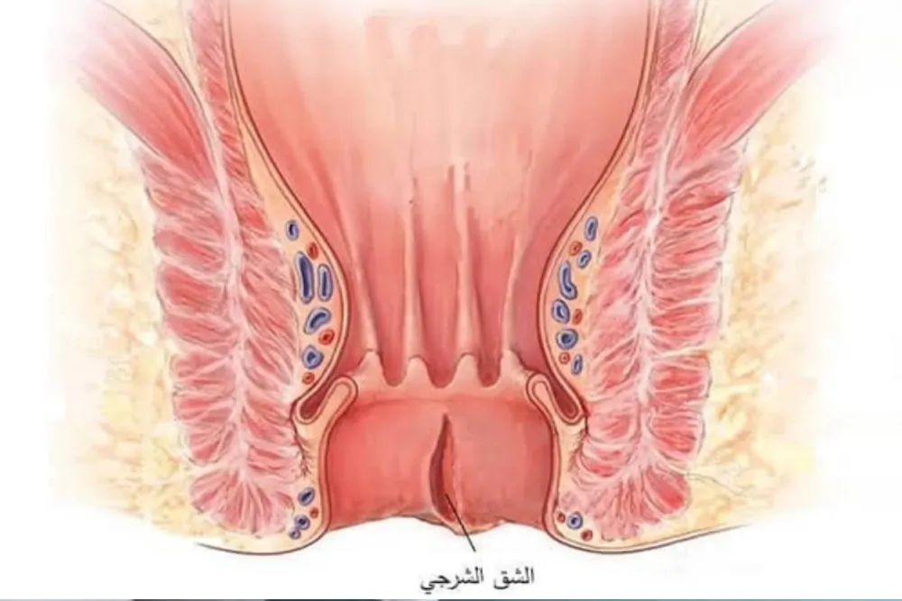 نصائح للوقاية من الشق الشرجي